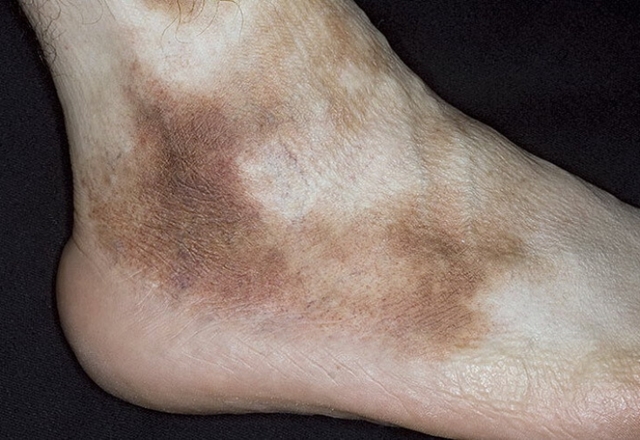 Гемосидероз кожи ног, тела: описание болезни Шамберга, диагностика, традиционные и народные методы терапии