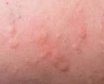 Генитальная аллергия: причины заболевания, сопутствующие симптомы, принципы лечения и меры профилактики