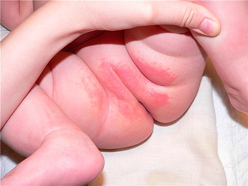 Генитальная аллергия: причины заболевания, сопутствующие симптомы, принципы лечения и меры профилактики