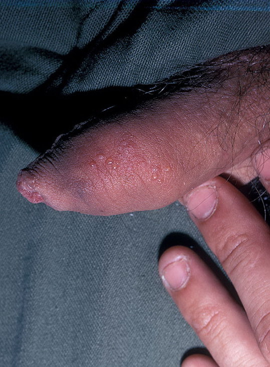 Генитальный герпес у мужчин: как происходит заражение, специфические симптомы и методы лечения, фото заболевания