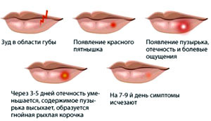 Герпес на губах при беременности в 1, 2, 3 триместре: пути заражения, характерные признаки, лечебная тактика