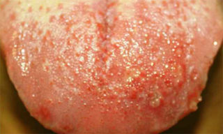 Герпетический стоматит: причины рецидивов, особенности заболевания у детей и взрослых, методы лечения