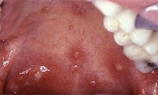 Герпетический стоматит: причины рецидивов, особенности заболевания у детей и взрослых, методы лечения