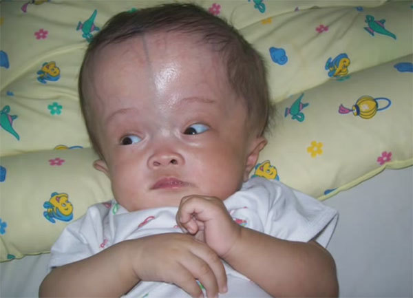 Гидроцефалия (водянка головного мозга) у новорожденных – симптомы и признаки