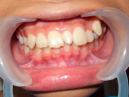 Гипердонтия, полиодонтия, гипердентия: причины аномалии числа зубов, методы лечения и возможные осложнения