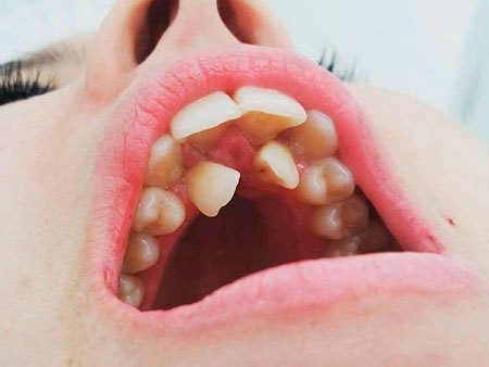 Гипердонтия, полиодонтия, гипердентия: причины аномалии числа зубов, методы лечения и возможные осложнения