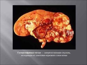 Гипернефроидный рак почки: механизм развития, характерные симптомы, способы лечения и прогноз