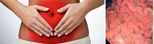Гипертрофический гастрит желудка: причины возникновения, сопутствующие симптомы, диета и принципы лечения