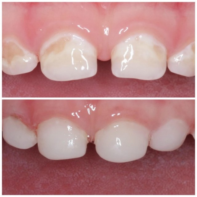 Гипоплазия эмали зубов: причины повреждения, стадии развития, методы терапии и профилактика