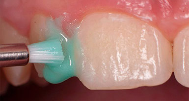 Гипоплазия эмали зубов: причины повреждения, стадии развития, методы терапии и профилактика
