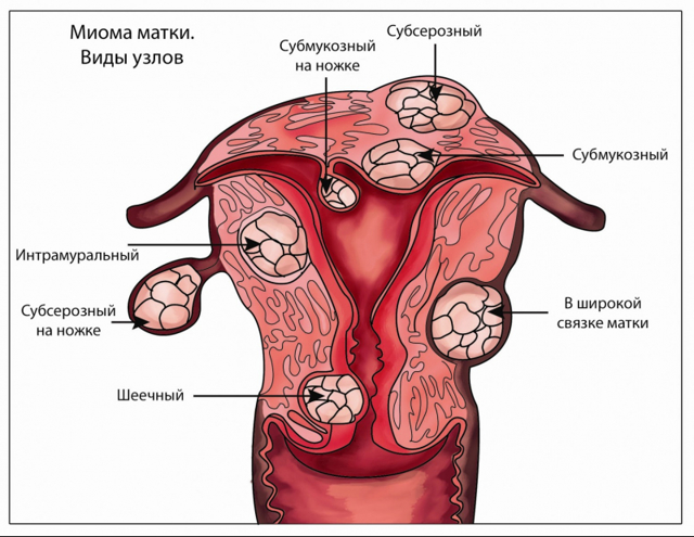 Гистерэктомия матки в гинекологии: показания и противопоказания, послеоперационный период, возможные последствия