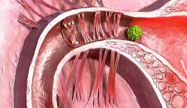 Гистеросальпингография ГСГ маточных труб - что такое в гинекологии, подготовка, как проходит процедура