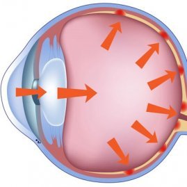 Глаукома: симптомы, причины, диагностика, профилактика и лечение
