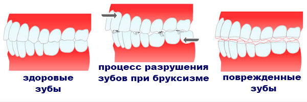 Глисты и скрежет зубами, глисты и дерматит, пути заражения глистами
