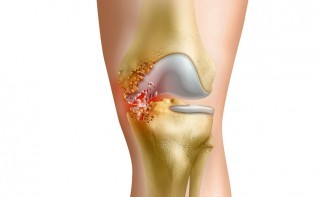 Гнойный артрит коленного, голеностопного, тазобедренного и плечевого сустава: провоцирующие факторы, характерные признаки, способы лечения
