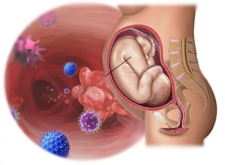 Гонорея при беременности: возбудитель заболевания, клинические признаки, методы терапии и последствия для плода
