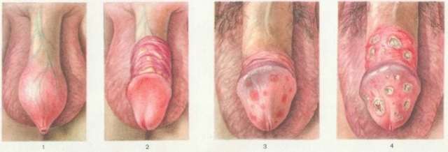Гонорея у женщин: первые признаки, симптомы и лечение, фото выделений при триппере