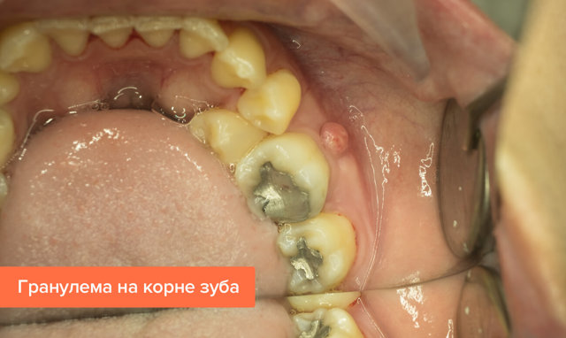 Гранулема зуба: стадии развития заболевания, основные признаки, особенности лечения