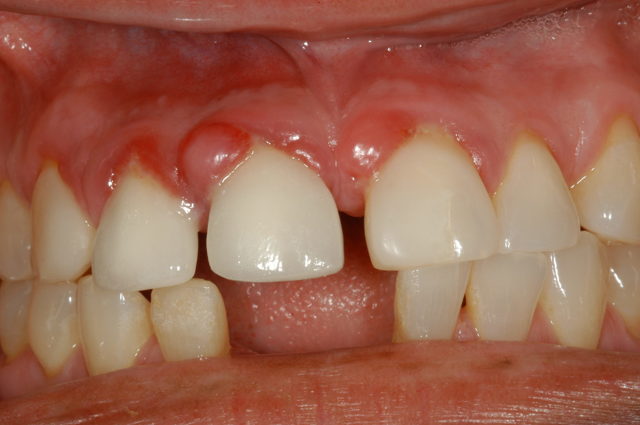 Гранулема зуба: стадии развития заболевания, основные признаки, особенности лечения