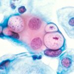 Хламидиоз у мужчин: как развивается инфекция, первые признаки и методы лечения