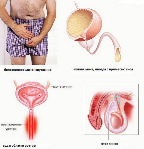 Хламидиоз у мужчин: как развивается инфекция, первые признаки и методы лечения