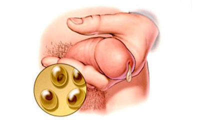 Хламидийный уретрит у мужчин и женщин: источник инфекции, характерные симптомы, методы обследования и лечения