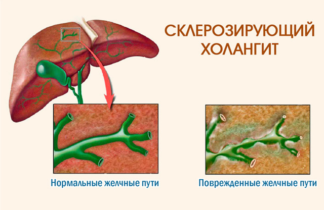 Холангит (воспаление жёлчных протоков): симптомы и профилактика болезни
