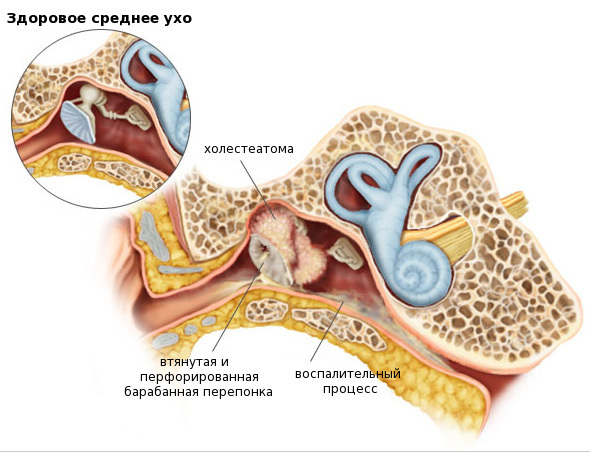 Холестеатома (сholesteatoma) уха: что это и как проявляется?