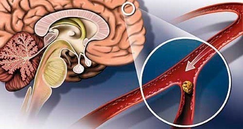 Хроническая недостаточность мозгового кровообращения: симптомы и лечение