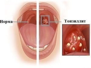 Хронический тонзиллит у взрослых: причины, диагностика и формы течения