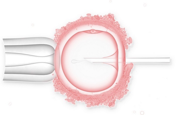 ИКСИ-оплодотворение: что это такое, основные различия репродуктивных технологий, показания и этапы проведения