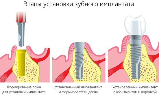 Имплантация зубов: виды операций, типы имплантов, показания и противопоказания