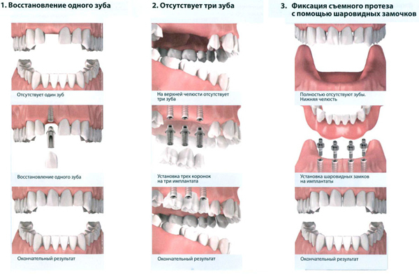 Имплантация зубов: виды операций, типы имплантов, показания и противопоказания