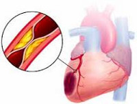 Инфаркт миокарда: симптомы и первые признаки инфаркта, причины развития, диагностика, методы лечения и меры первой помощи при инфаркте