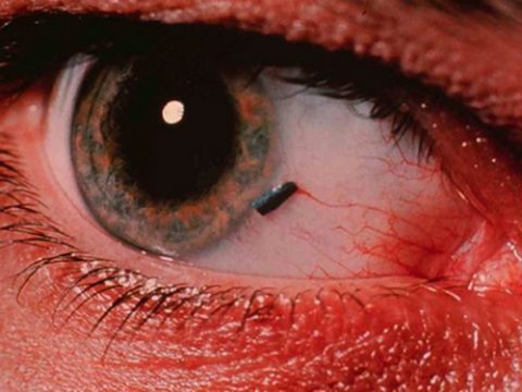 Инородное тело глаза: что делать, если что-то попало в глаз под верхнее веко, как извлечь
