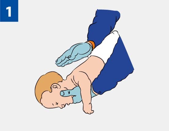 Инородное тело в дыхательных путях у ребенка и у взрослого: первая помощь при асфиксии