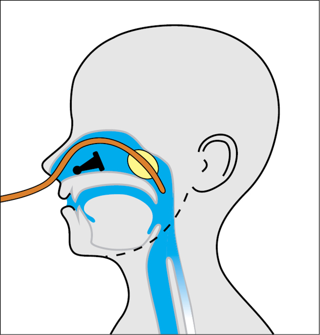 Инородное тело в носу у ребенка: симптомы, первая помощь, удаление инородного тела