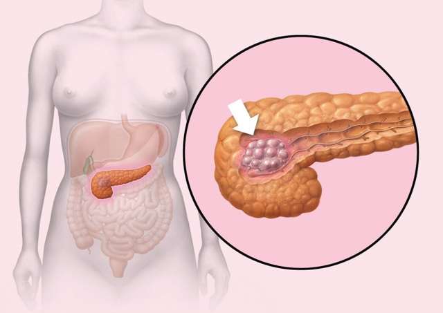 Инсулинома поджелудочной железы: причины возникновения, характерные симптомы, методы обследования и лечения
