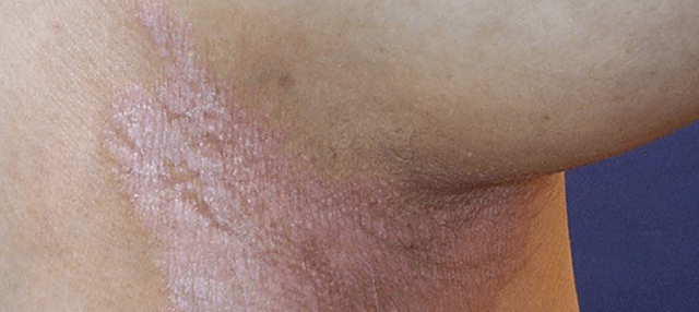 Интертригинозный псориаз складок кожи: причины развития заболевания, диагностика, способы терапии, прогноз врачей