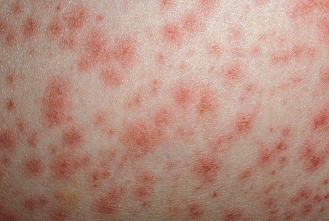 Интертригинозный псориаз складок кожи: причины развития заболевания, диагностика, способы терапии, прогноз врачей