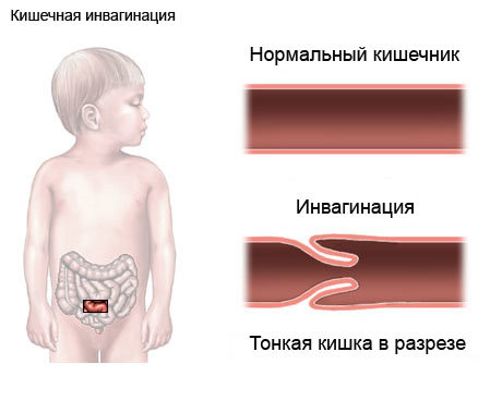 Инвагинация кишечника у детей: причины и симптомы патологии, методы лечения и последствия