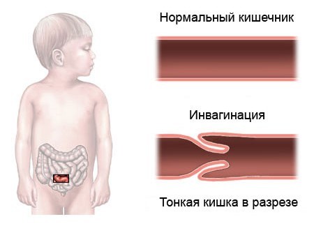 Инвагинация кишечника у детей: причины и симптомы патологии, методы лечения и последствия