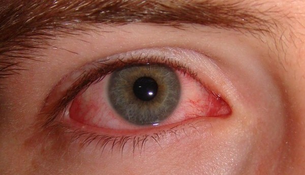 Ирит глаза: причины воспаления, симптомы и методы лечения у детей и взрослых