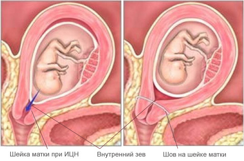 Истмико-цервикальная недостаточность во время беременности: описание патологии, методы диагностики и лечения, как сохранить беременность