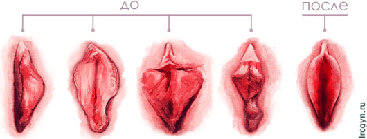 Как исправить дряблые и обвисшие половые губы – есть ли шанс вернуть молодость интимному органу?