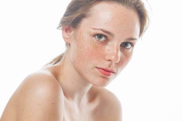 Как избавиться от веснушек: кремы и средства от гиперпигментации кожи лица