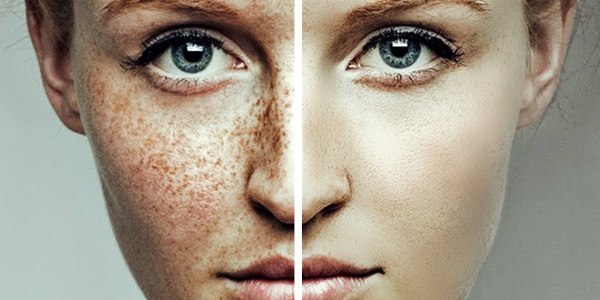 Как избавиться от веснушек: кремы и средства от гиперпигментации кожи лица