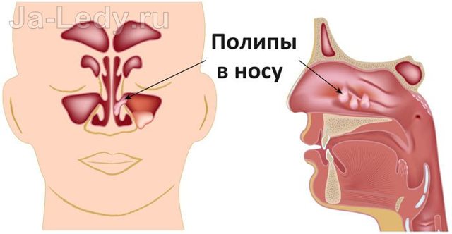 Как избавиться от заложенности носа без насморка: причины развития, способы лечения и профилактические мероприятия