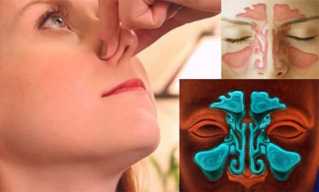 Как избавиться от заложенности носа без насморка: причины развития, способы лечения и профилактические мероприятия