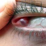Как лечить чирей на глазу, лечение фурункула на глазу